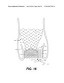 Paravalvular Leak Occlusion Device for Self-Expanding Heart Valves diagram and image