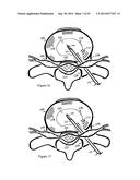 Tissue Repair with Space-Seeking Spirals of Filament diagram and image