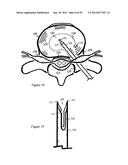 Tissue Repair with Space-Seeking Spirals of Filament diagram and image