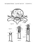 Tissue Repair with Space-Seeking Spirals of Filament diagram and image