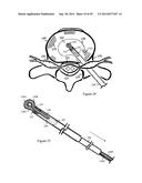 Tissue Repair with Space-Seeking Spirals of Filament diagram and image