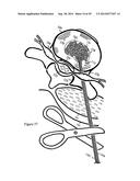 Tissue Repair with Space-Seeking Spirals of Filament diagram and image