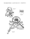 Tissue Repair with Space-Seeking Spirals of Filament diagram and image