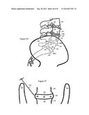 Tissue Repair with Space-Seeking Spirals of Filament diagram and image