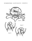 Tissue Repair with Space-Seeking Spirals of Filament diagram and image