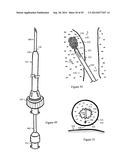 Tissue Repair with Space-Seeking Spirals of Filament diagram and image