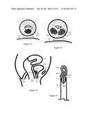 Tissue Repair with Space-Seeking Spirals of Filament diagram and image