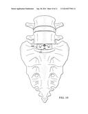 Bone Fusion Implant Device diagram and image