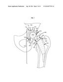 ARTIFICIAL JOINT COMPONENTS INCLUDING SYNOVIAL FLUID DEFLECTING STRUCTURES diagram and image