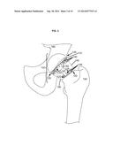 ARTIFICIAL JOINT COMPONENTS INCLUDING SYNOVIAL FLUID DEFLECTING STRUCTURES diagram and image