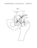 ARTIFICIAL JOINT COMPONENTS INCLUDING SYNOVIAL FLUID DEFLECTING STRUCTURES diagram and image