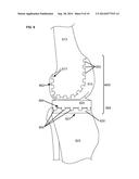 ARTIFICIAL JOINT COMPONENTS INCLUDING SYNOVIAL FLUID DEFLECTING STRUCTURES diagram and image