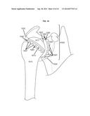 ARTIFICIAL JOINT COMPONENTS INCLUDING SYNOVIAL FLUID DEFLECTING STRUCTURES diagram and image