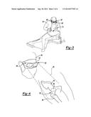 METHOD FOR IMPLANTING A HIP PROSTHESIS AND RELATED SYSTEM diagram and image