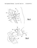 METHOD FOR IMPLANTING A HIP PROSTHESIS AND RELATED SYSTEM diagram and image