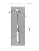 Acetabular Fixation System and Method diagram and image