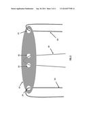 Acetabular Fixation System and Method diagram and image