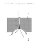 Acetabular Fixation System and Method diagram and image