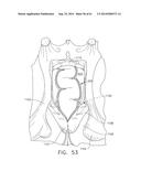 TISSUE ACQUISITION ARRANGEMENTS AND METHODS FOR SURGICAL STAPLING DEVICES diagram and image