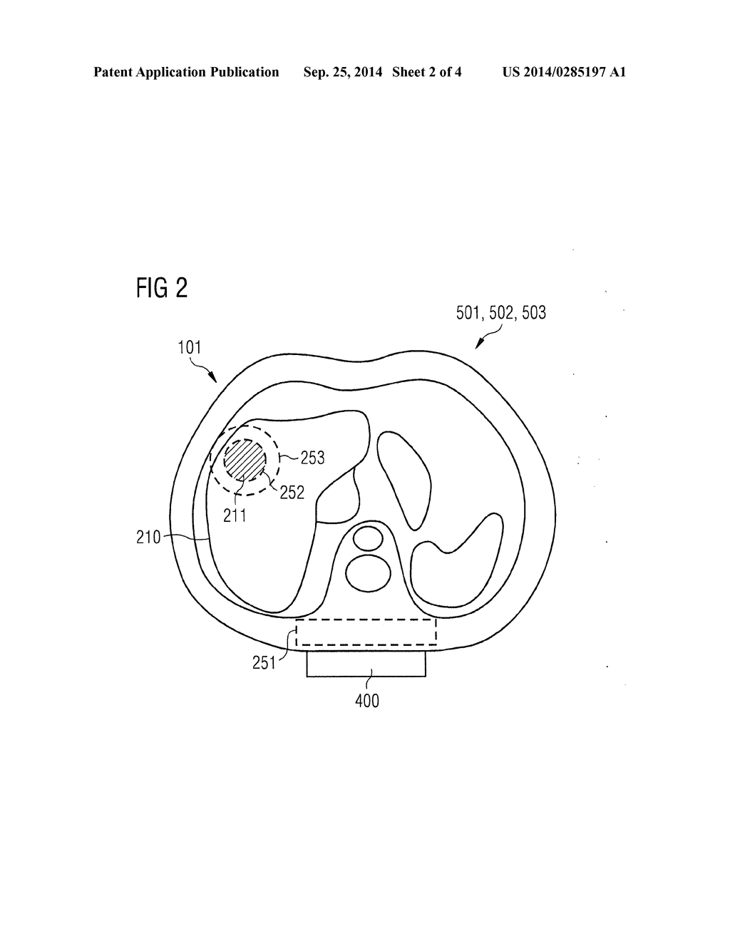 METHOD AND MAGNETIC RESONANCE SYSTEM FOR MAGNETIC RESONANCE THERMOMETRY - diagram, schematic, and image 03