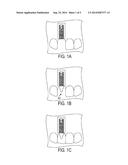 GUIDED DENTAL IMPLANTATION SYSTEM AND ASSOCIATED DEVICE AND METHOD diagram and image