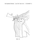 Retractable Cannula for Surgical Procedures diagram and image