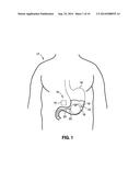 Intragastric Volume Occupying Device with Active Agents diagram and image