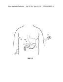 Intragastric Volume Occupying Device with Active Agents diagram and image