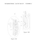 LESION TREATMENT DEVICE AND METHODS FOR TREATING LESIONS diagram and image