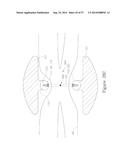 LESION TREATMENT DEVICE AND METHODS FOR TREATING LESIONS diagram and image