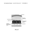 SYSTEMS AND METHODS FOR PROSTATE TREATMENT diagram and image