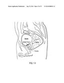 SYSTEMS AND METHODS FOR PROSTATE TREATMENT diagram and image