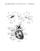 ABLATION CATHETER diagram and image