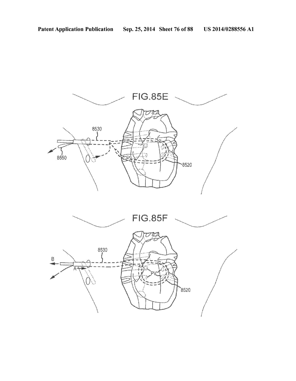 CARDIAC ABLATION SYSTEMS AND METHODS - diagram, schematic, and image 77