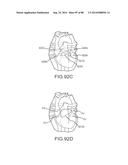 CARDIAC ABLATION SYSTEMS AND METHODS diagram and image