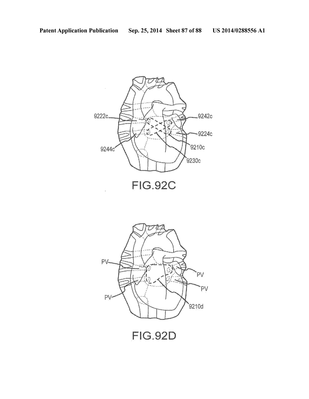 CARDIAC ABLATION SYSTEMS AND METHODS - diagram, schematic, and image 88