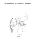 KNEE ARTHROPLASTY INSTRUMENT diagram and image