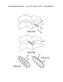 VERTEBRAL JOINT IMPLANTS AND DELIVERY TOOLS diagram and image