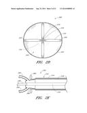 VASCULAR PLAQUE REMOVAL SYSTEMS, DEVICES, AND METHODS diagram and image