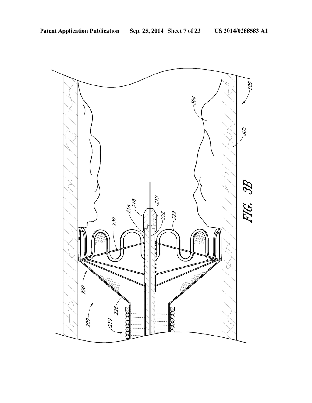 VASCULAR PLAQUE REMOVAL SYSTEMS, DEVICES, AND METHODS - diagram, schematic, and image 08