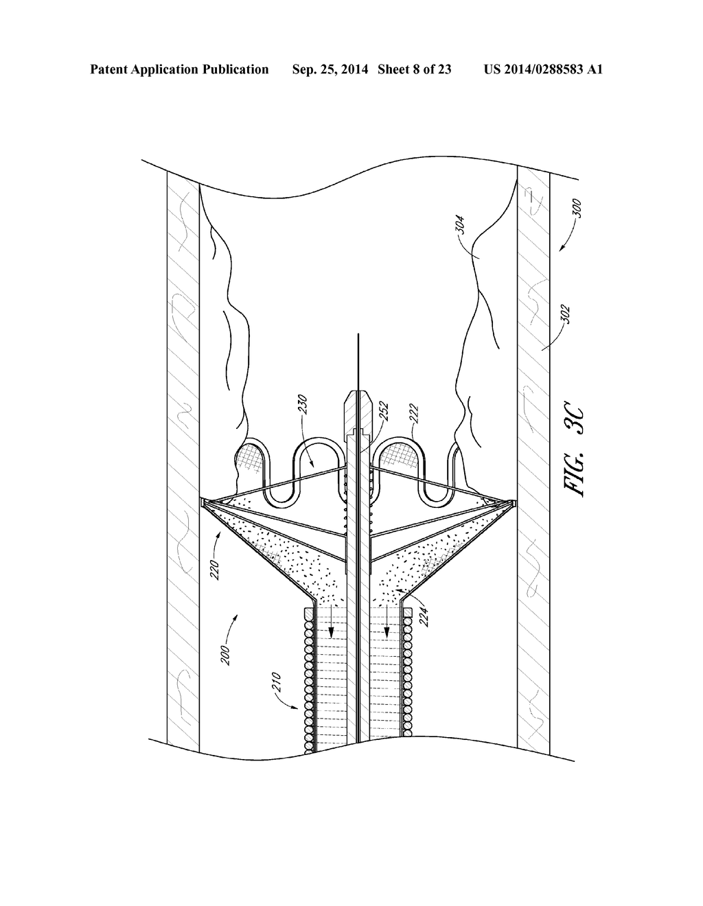 VASCULAR PLAQUE REMOVAL SYSTEMS, DEVICES, AND METHODS - diagram, schematic, and image 09