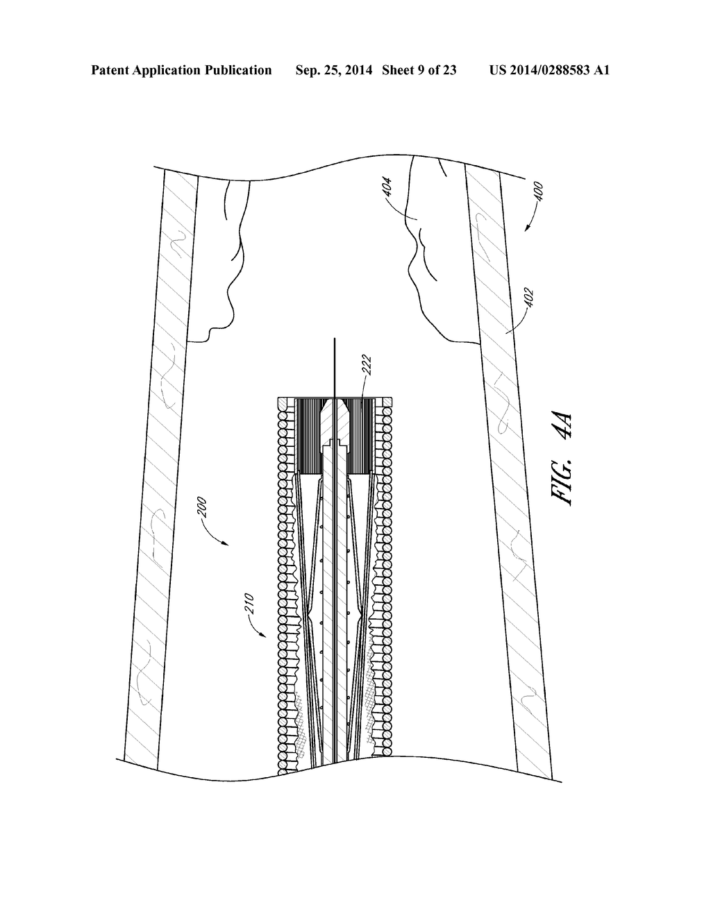 VASCULAR PLAQUE REMOVAL SYSTEMS, DEVICES, AND METHODS - diagram, schematic, and image 10