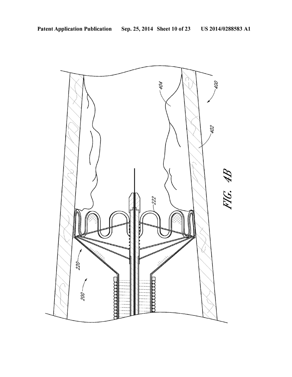 VASCULAR PLAQUE REMOVAL SYSTEMS, DEVICES, AND METHODS - diagram, schematic, and image 11