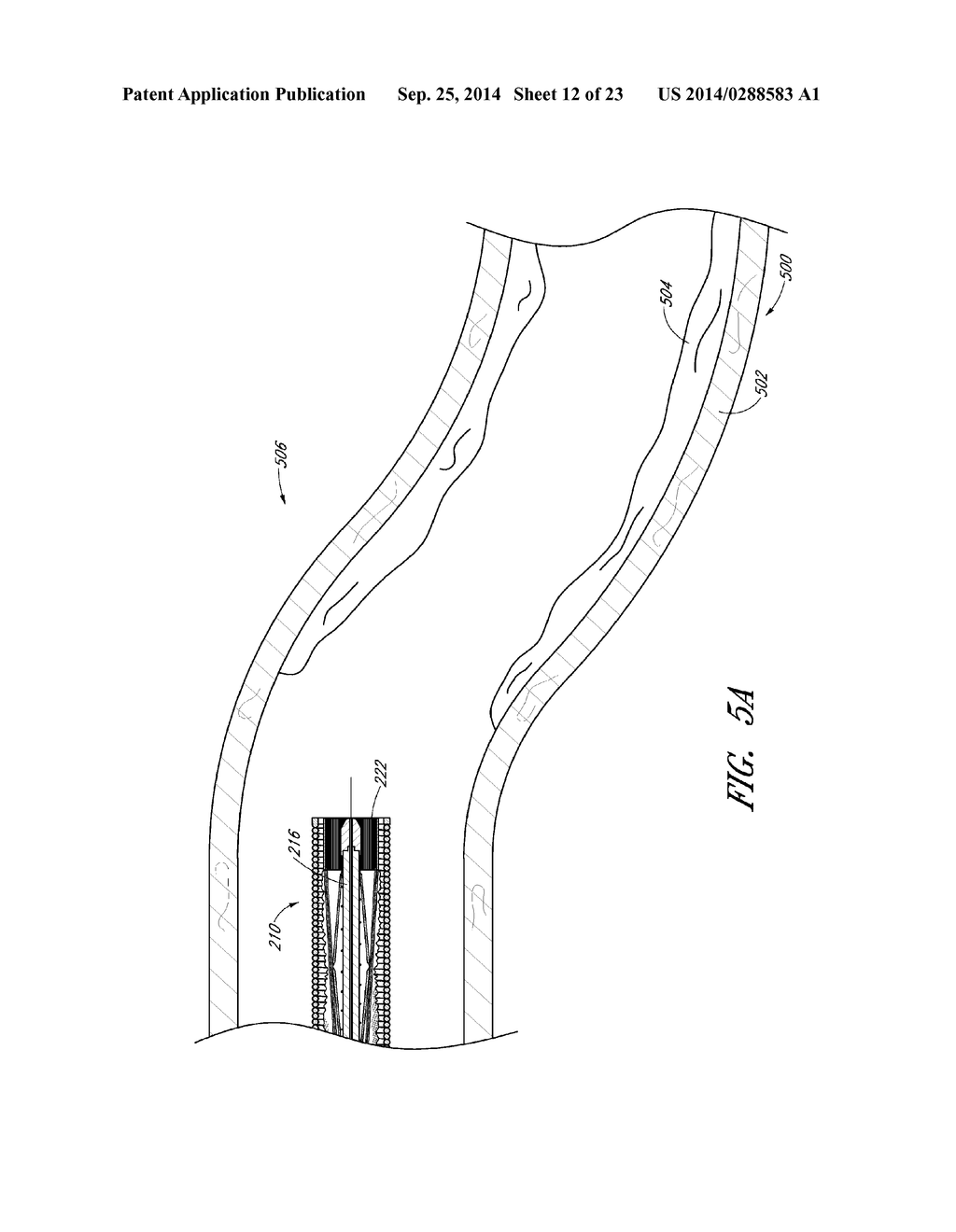 VASCULAR PLAQUE REMOVAL SYSTEMS, DEVICES, AND METHODS - diagram, schematic, and image 13