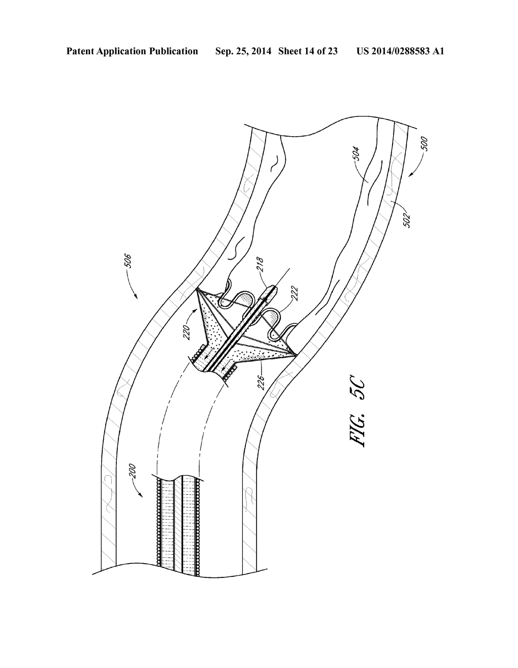 VASCULAR PLAQUE REMOVAL SYSTEMS, DEVICES, AND METHODS - diagram, schematic, and image 15