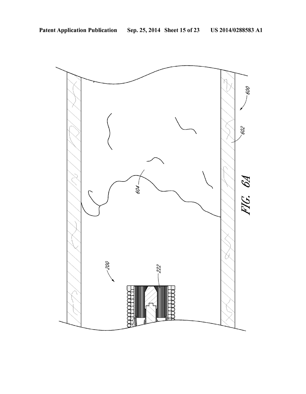 VASCULAR PLAQUE REMOVAL SYSTEMS, DEVICES, AND METHODS - diagram, schematic, and image 16