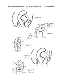 Methods for Anchoring Suture and Approximating Tissue diagram and image