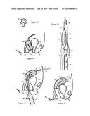 Methods for Anchoring Suture and Approximating Tissue diagram and image