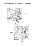 Methods for Anchoring Suture and Approximating Tissue diagram and image