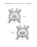 Methods for Anchoring Suture and Approximating Tissue diagram and image